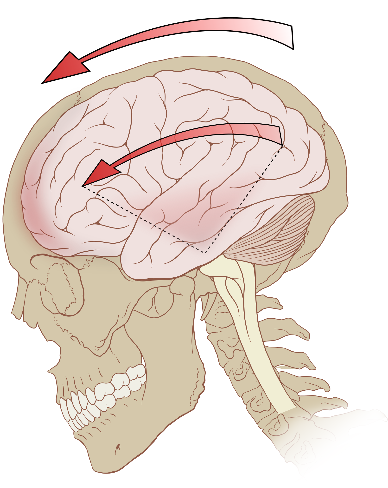 3 сотрясения мозга. Сотрясение головного мозга. Контузия головного мозга. Черепно-мозговая травма. Травма- сотрясение головного мозга.